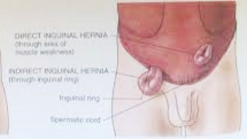 Mengenal Hernia Inguinalis, Benarkah Rentan Dialami oleh Bayi Prematur?