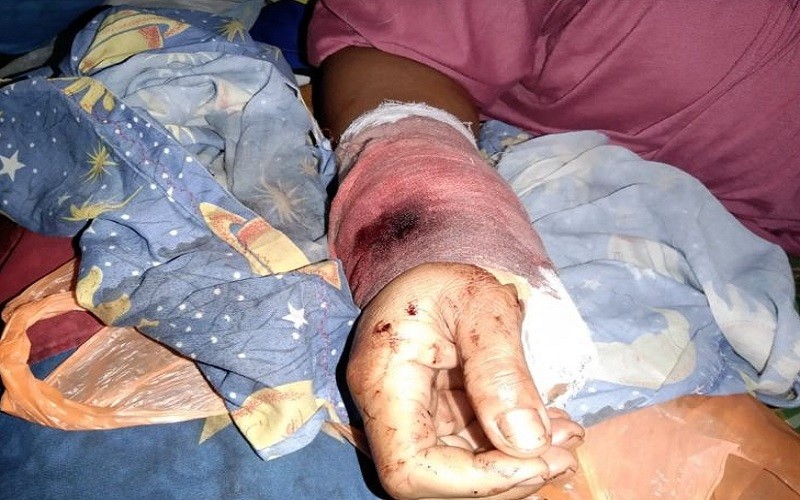 Sengit! Ibu Rumah Tangga Bergelut lawan Buaya Berhasil Selamat meski Tangan Terluka