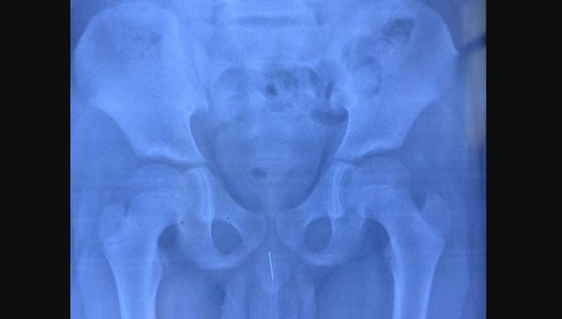 Ngilu! Ada Jarum 8 Cm di Penis Bocah 11 Tahun, kok Bisa?