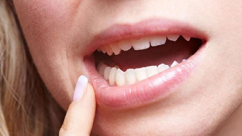 5 Obat Sariawan saat Puasa dan Cara Menggunakannya