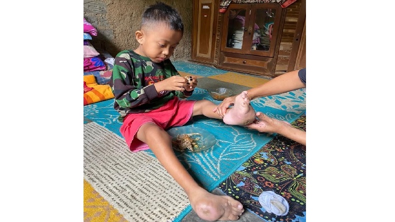 Anak 7 Tahun di Sukabumi Tanpa Anus dan Kelamin Butuh Biaya Pengobatan