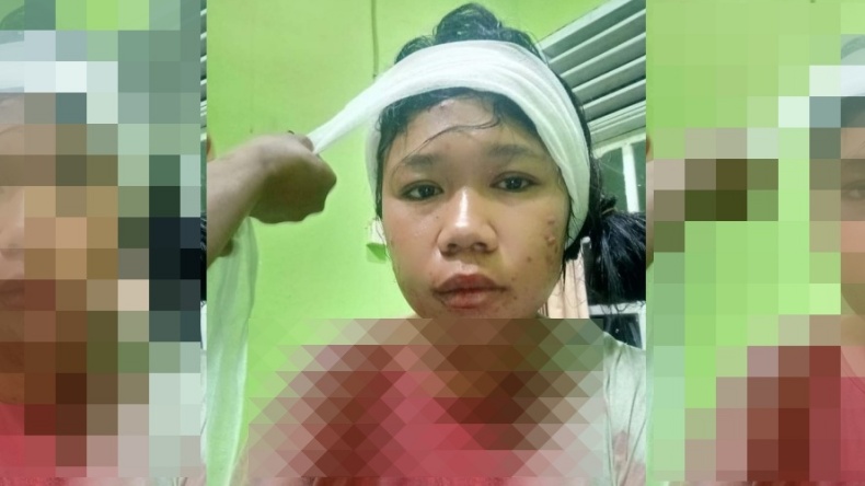 Mama Muda Dirampok saat Sendiri di Rumah, Kepala Dihantam Balok hingga Dapat 19 Jahitan
