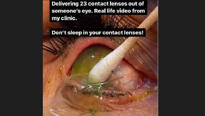 Merinding! Dokter Ini Berhasil Keluarkan 23 Lensa Kontak dari Mata Pasien