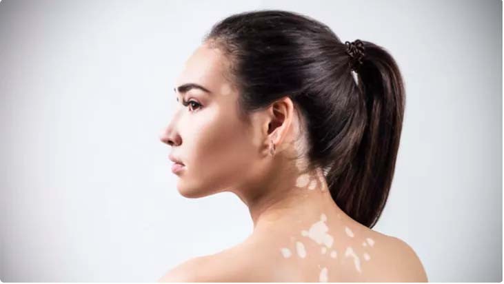 Vitiligo Penyakit Apa, Timbulkan Kelainan pada Kulit Bikin Tak Percaya Diri  