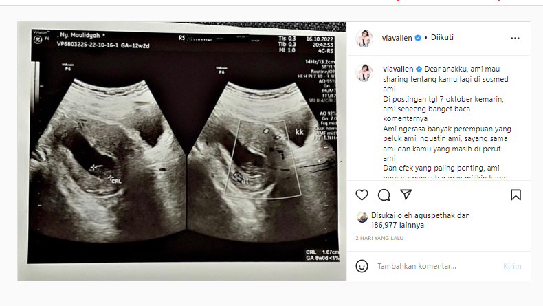 Via Vallen Curhat Pilu tentang Janinnya yang Tidak Berkembang, Harus Digugurkan?