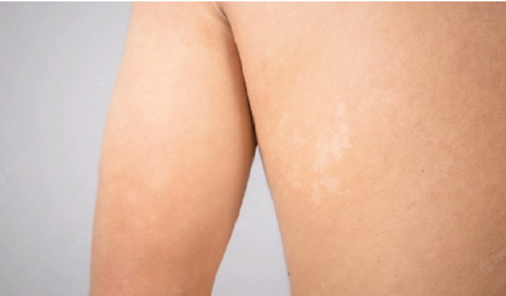 Ini 5 Cara Menghilangkan Panu Sampai ke Akarnya, Bisa Menggunakan Kunyit hingga Lidah Buaya