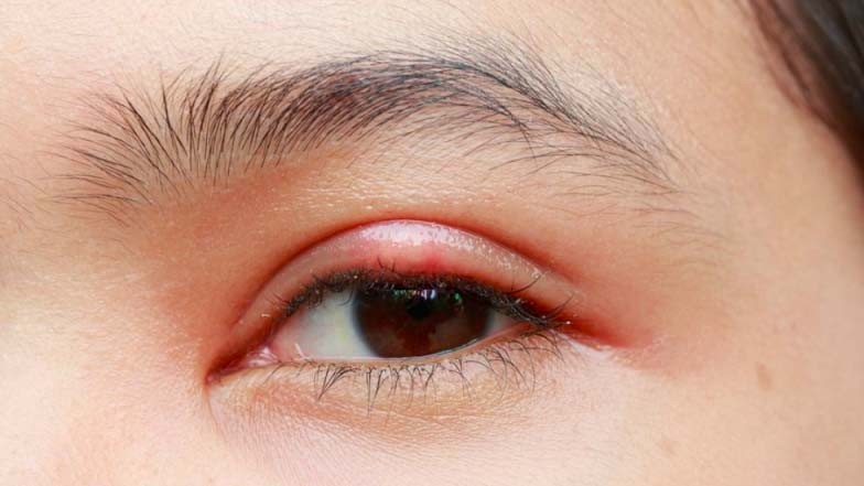 Ini 4 Cara Mengobati Mata yang Ada Benjolan, Bisa Pakai Garam hingga Kantong Teh