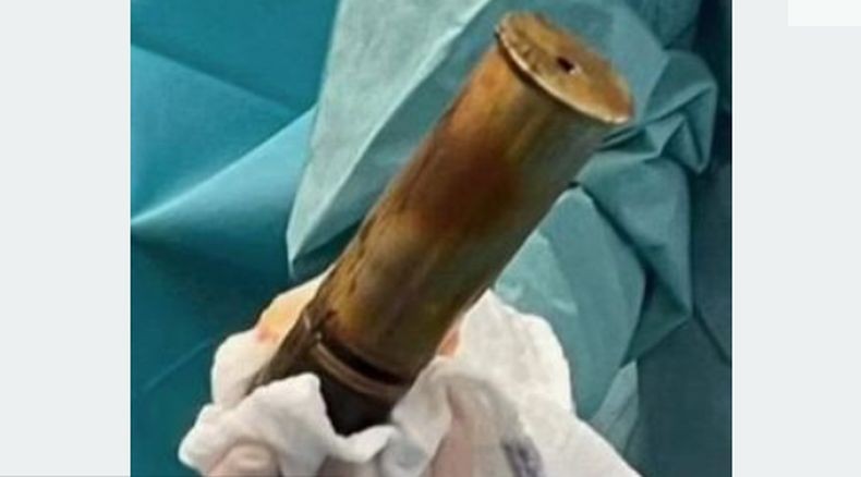 Ada-Ada Saja, Pria Ini Masukkan Peluru Artileri ke Anus Bikin Panik Rumah Sakit