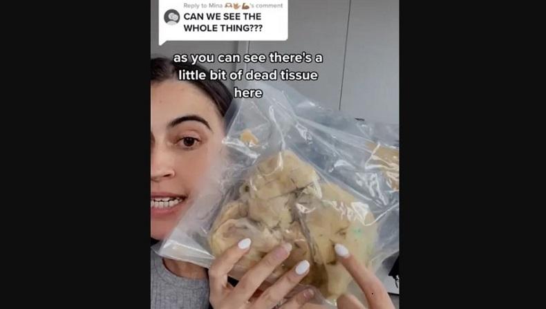 Tindakan Tak Biasa, Perempuan Ini Simpan Organ Jantungnya dalam Kantong Plastik