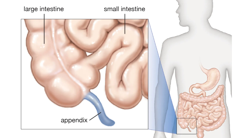 7 Ciri-ciri Awal Usus Buntu, Waspadai Gejala Berikut Ini!