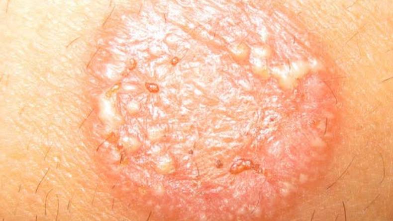 5 Cara Mudah Menghilangkan Kurap dengan Cepat Dalam 1 Hari, Simak Tips Berikut Ini!