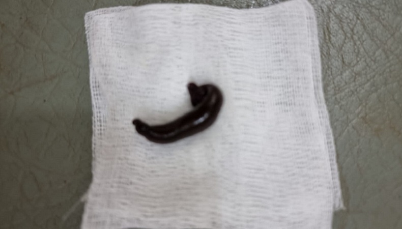 Merinding, Hidung Pemuda Bogor Kemasukan Lintah gegara Cuci Muka di Sawah