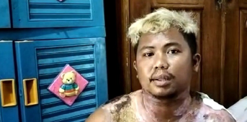 Sulit Makan hingga Tidur, Korban Penyiraman Air Keras di Jakut Minta Polisi Segera Tangkap Pelaku