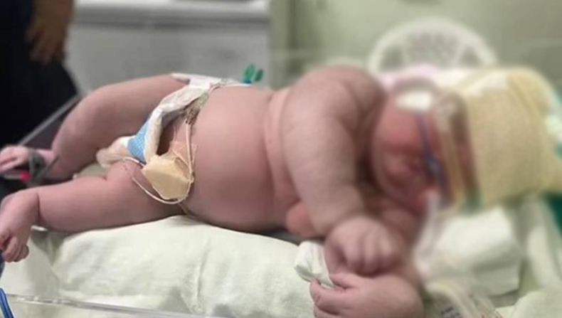 Rekor, Bayi Perempuan Ini Lahir dengan Berat 7,3 Kg