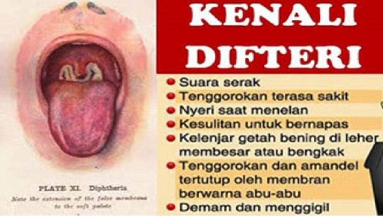 Difteri Ancam Kesehatan Masyarakat, Dinkes KBB Waspada dan Lakukan Deteksi Dini