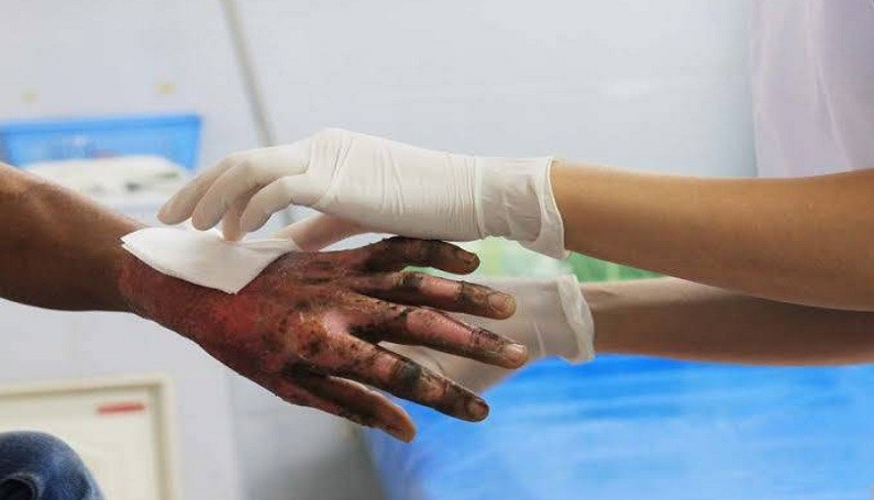 3 Cara Mengobati Luka Bakar agar Cepat Kering, Jangan Sembarangan Pakai Obat