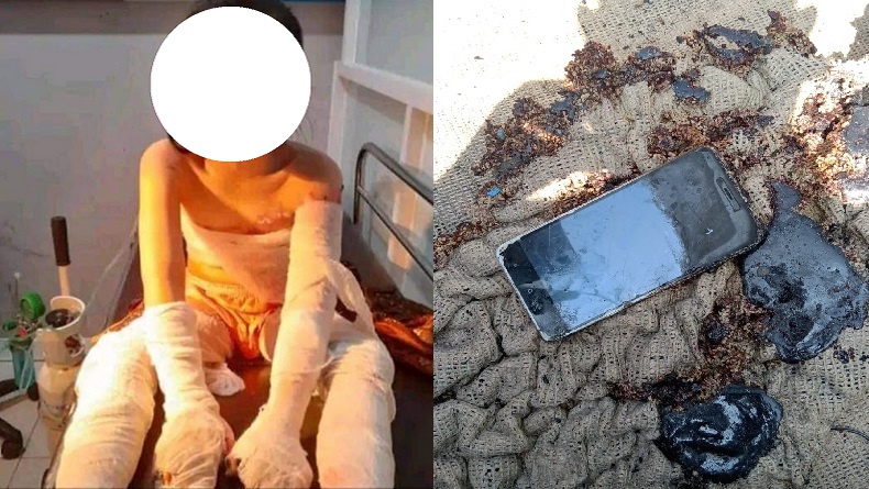 HP Meledak saat Dimainkan sambil Dicas, Bocah di Sukabumi Luka Bakar Sekujur Tubuh 