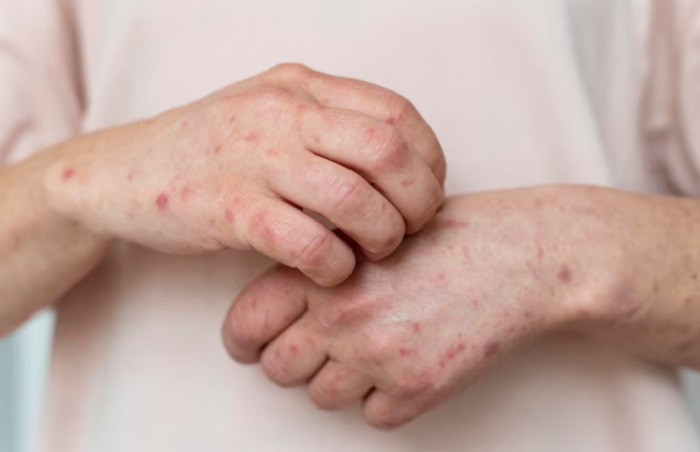 Pakar UGM Buka Suara soal Kasus HIV dan Sifilis yang Meningkat di Indonesia