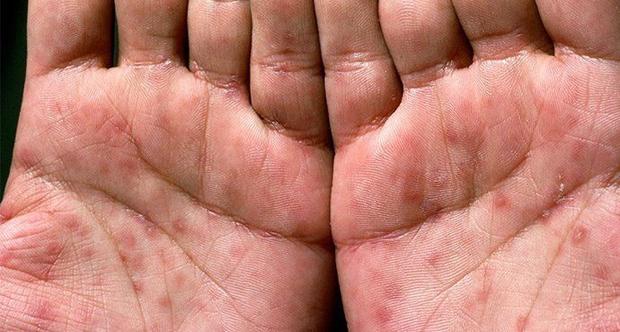 Fakta-Fakta Sifilis, Penyakit Kelamin yang Sedang Melonjak di AS