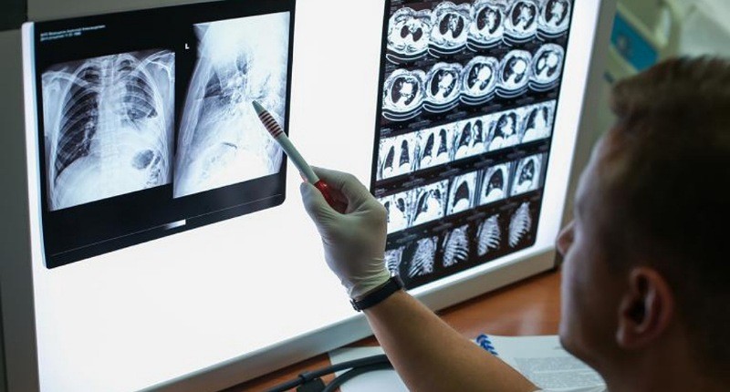 Mengenal Penyakit Paru Obstruktif Kronik, Disebabkan karena Asap Rokok dan Polusi Udara 