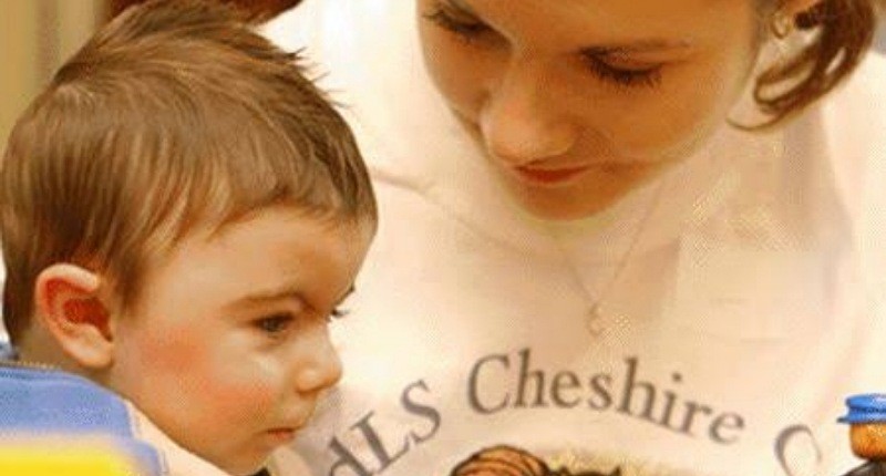 Mengenal Sindrom Cornelia, Kelainan Genetik Langka pada Anak dan Pencegahannya 