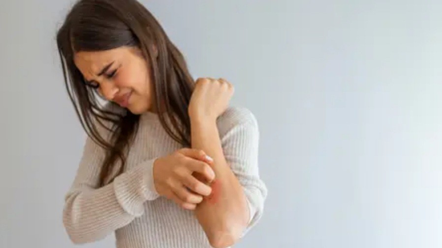 Catat 4 Makanan Tidak Boleh Dimakan saat Kurap, Fatal Akibatnya