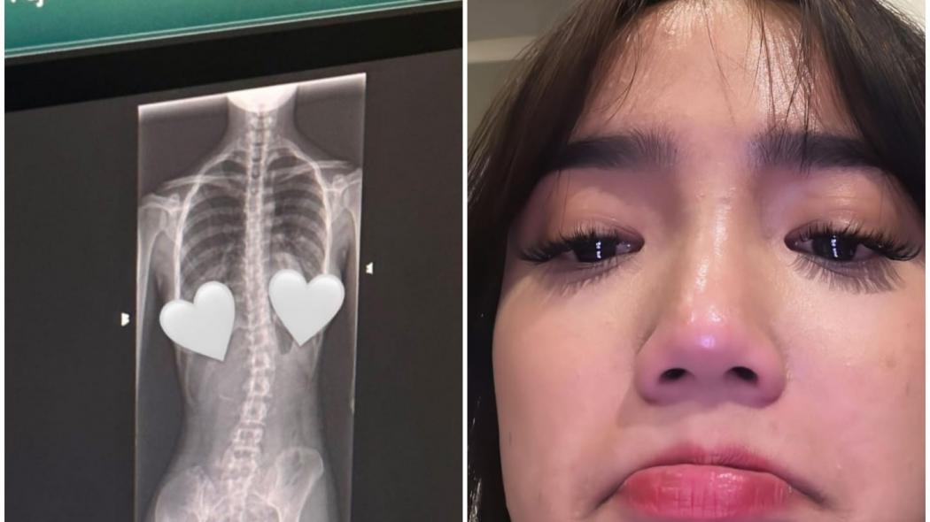 Fuji Curhat hingga Menangis akibat Skoliosis, Tulang Belakang Bengkok ke Kiri