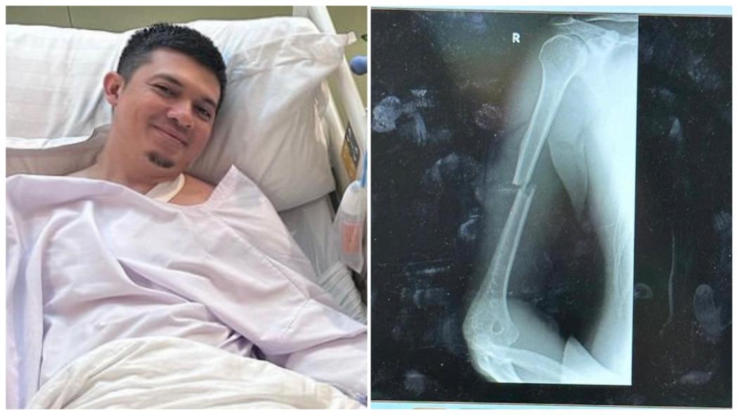 Irwansyah Patah Tulang karena Jatuh saat Berkuda, Begini Kabar Terbarunya