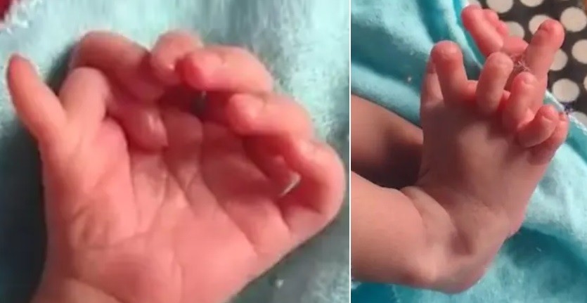 Viral Bayi Lahir Memiliki 26 Jari Tangan dan Kaki, Keluarga Percaya Reinkarnasi Dewi Hindu