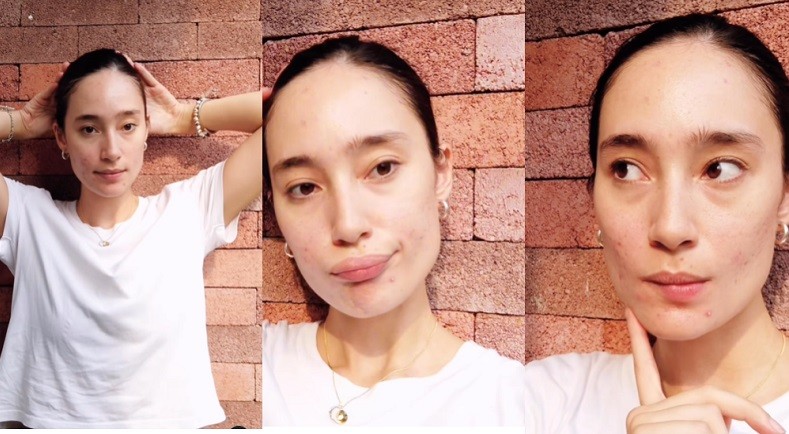 Potret Artis Tak Malu Pamer Wajah Jerawatan, Malah Dipuji Netizen