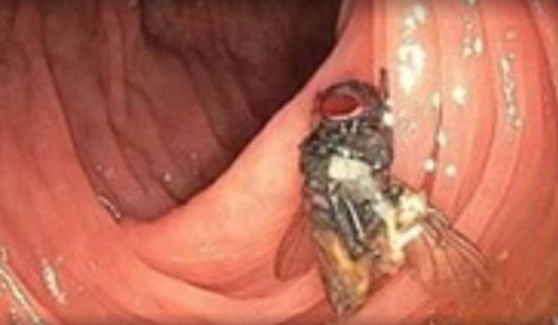 Seekor Lalat Hidup Ditemukan di Dalam Usus Pasien, kok Bisa?
