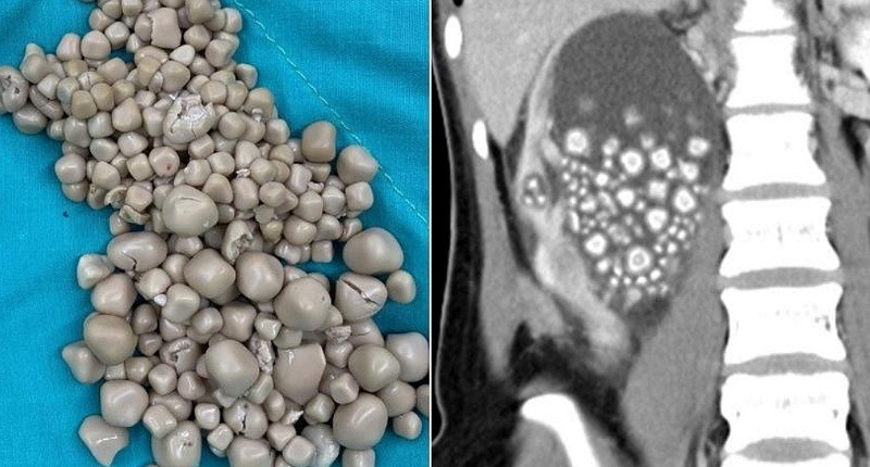 Viral, Seorang Perempuan Kecanduan Makan Boba sampai Punya 300 Batu Ginjal