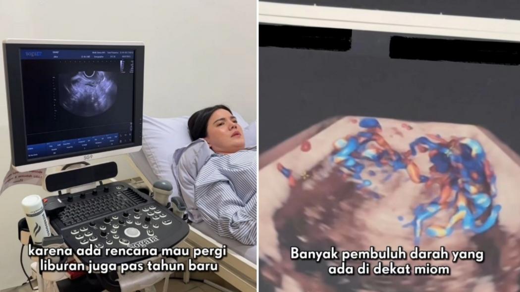 Alice Norin Ungkap Kena Kanker Sarkoma: Nyeri Banget