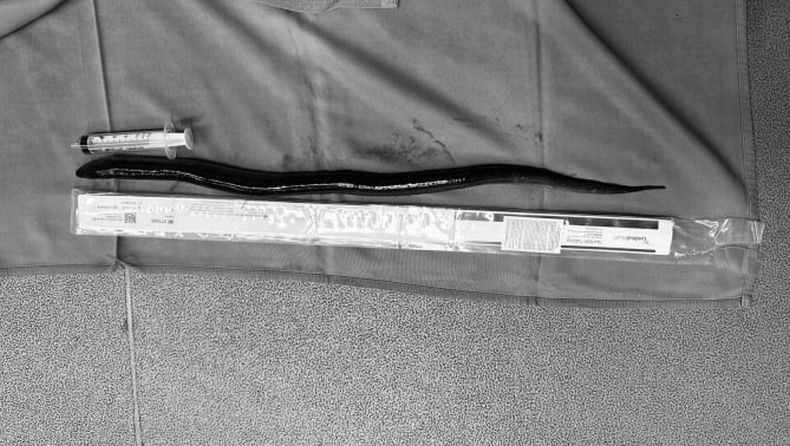 Waduh, Belut Hidup Sepanjang 30 Cm Ditemukan di Dalam Perut Pria Ini