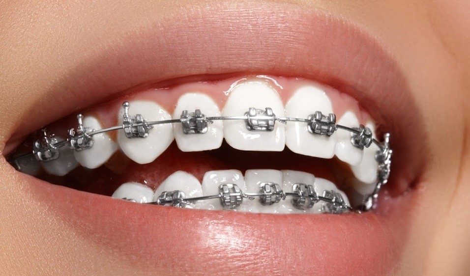 Jangan Asal Pasang Behel, Pilih yang Memiliki Bahan Logam Berkualitas Tinggi