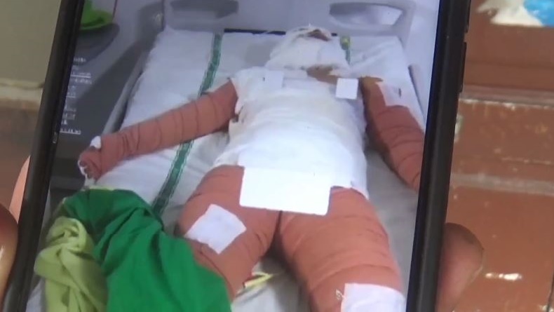 Ngeri! Perempuan di Deliserdang Dibakar Hidup-Hidup Eks Karyawan, Kondisinya Memilukan