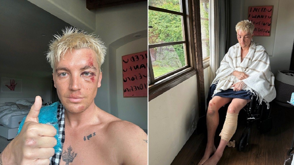 Kondisi Terkini Paul LANY usai Kecelakaan: Masih Kesulitan Berjalan dan Bergerak