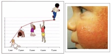 Ciri-Ciri Anak Alergi Susu Sapi, Jangan Anggap Sepele Begini Dampaknya