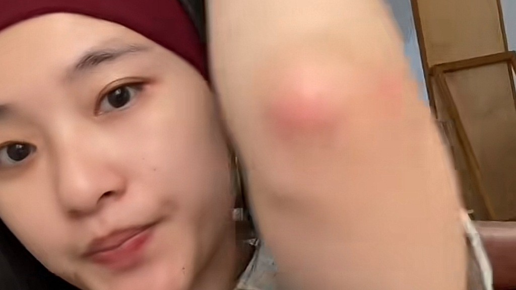 Viral Kisah Perempuan Terkena Ringworm usai Pakai Matras Gym, Imbau Netizen Berhati-hati