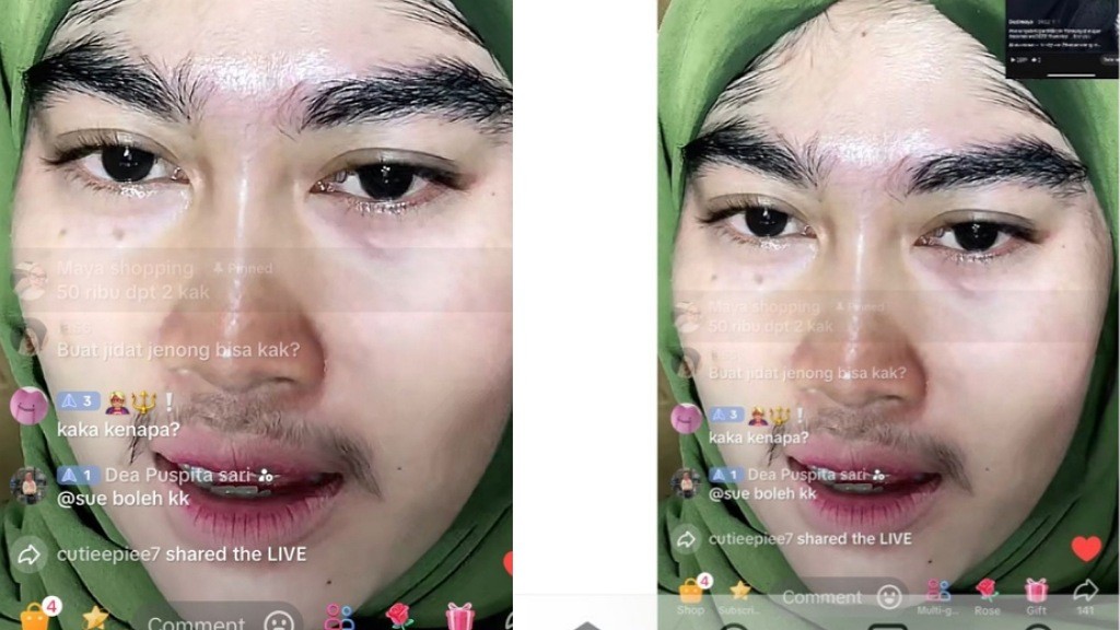 Viral Wajah Seorang Wanita Muncul Bulu Lebat di Wajah usai Pakai Skincare