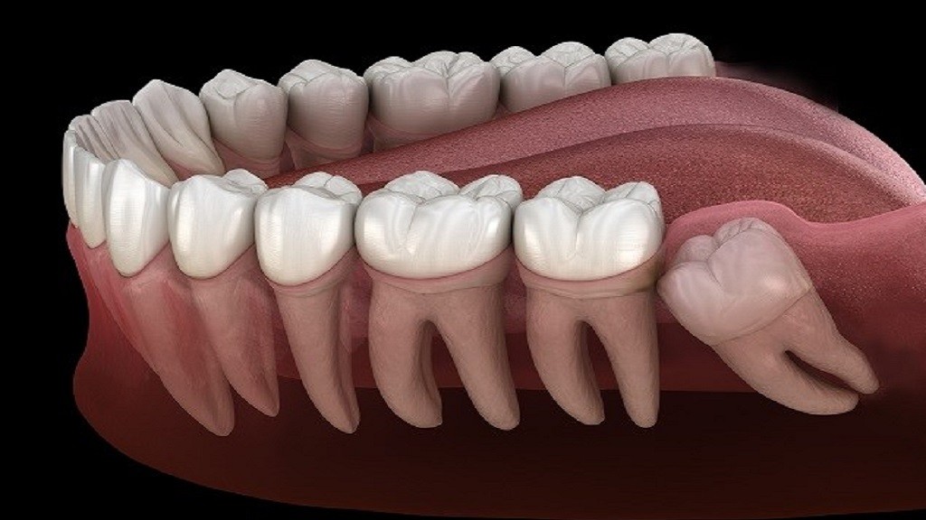 Impaksi Gigi Menyebabkan Sakit Kepala, Ini Hubungan dan Penanganannya