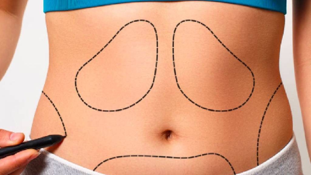 Jangan Asal Sedot Lemak,  Pastikan Dokter dan Kliniknya Gak Abal-Abal 