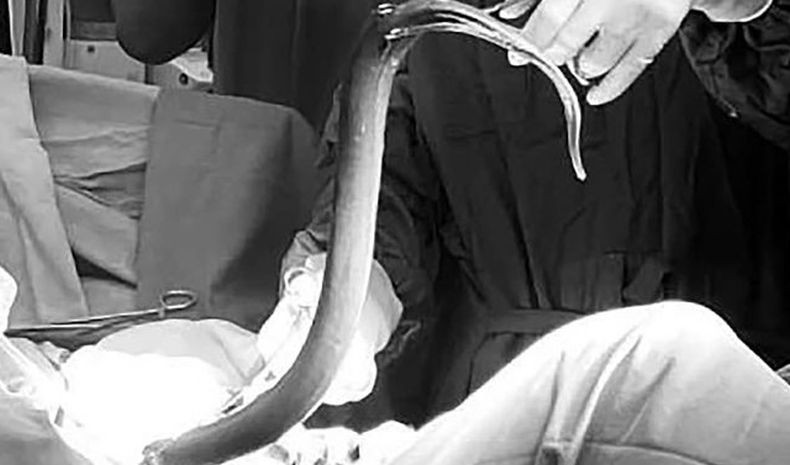 Wah! Belut Hidup Sepanjang 65 Cm Ditemukan di Dalam Perut Pria Ini