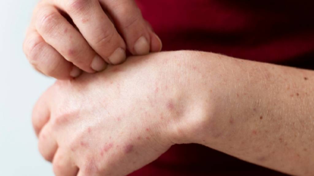 Penyakit Kusta Mewabah di Negeri Sembilan Malaysia, Indonesia Harus Waspada?