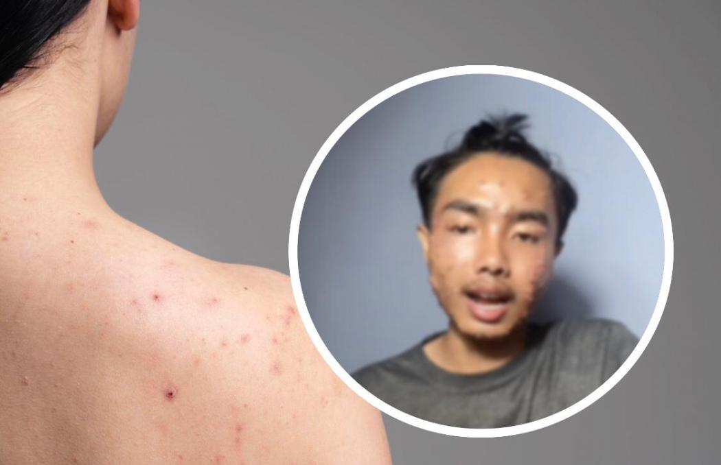 Heboh gegara Baju Thrifting Pria Ini Kena Penyakit Kulit Mengerikan, Ini Faktanya! 