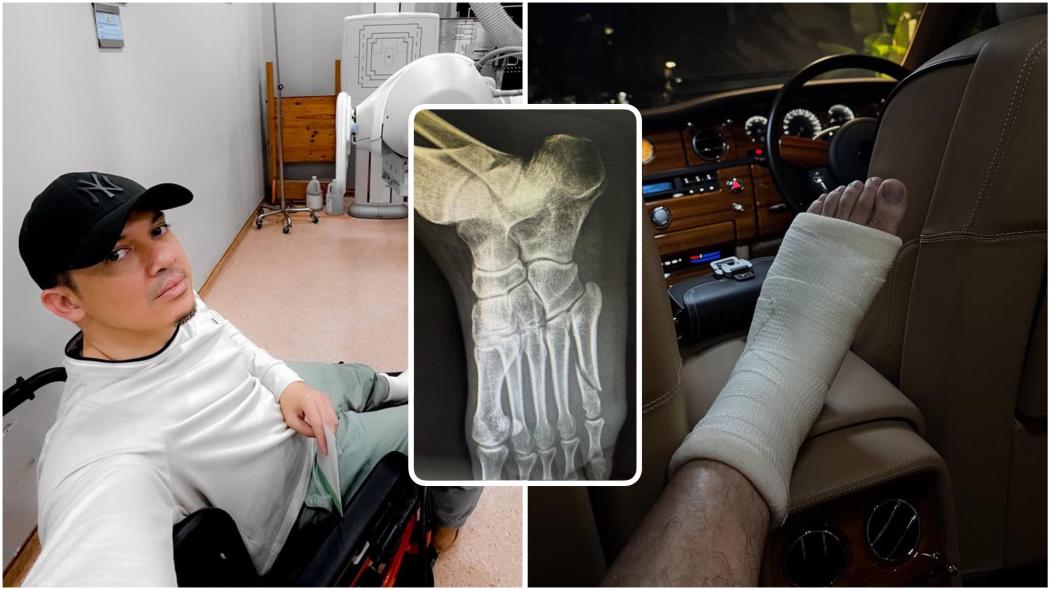 Astaghfirullah, Kaki Irwansyah Patah: Alhamdulillah Penggugur Dosa