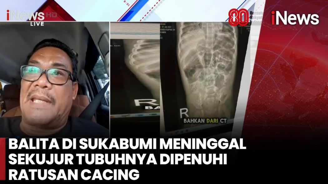 Hidung Keluar Cacing Hidup, Balita Sukabumi Meninggal Setelah 8 Hari Dirawat