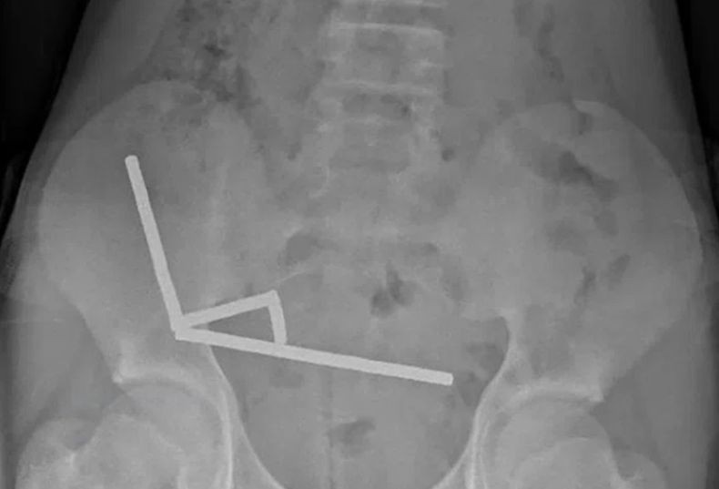 Duh! Bocah 13 Tahun Telan 100 Magnet Neodymium, Berujung di Meja Operasi