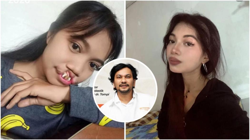 Viral Transformasi TikToker Rista, Pasien Bibir Sumbing yang Dioperasi Gratis Dokter Tompi!