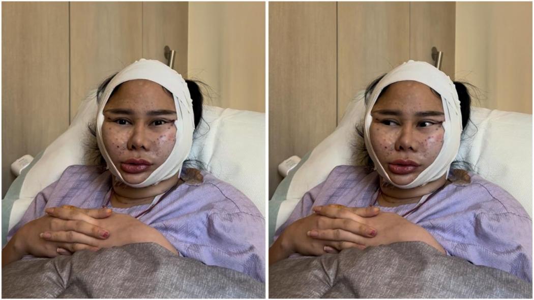 Muka Denise Chariesta Mendadak Bengkak dan Sulit Bicara, Ini Faktanya!